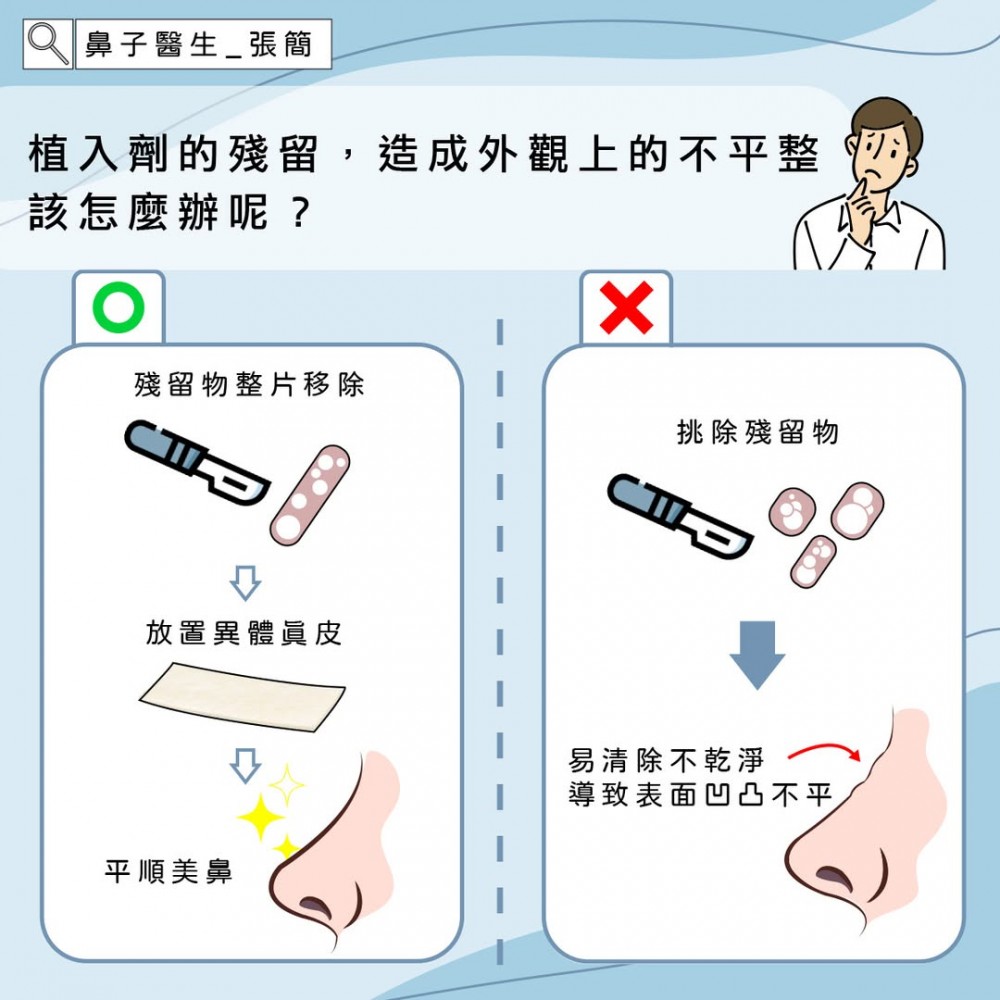 玻尿酸隆鼻植入劑殘留物清除,鼻重修,博恩妍